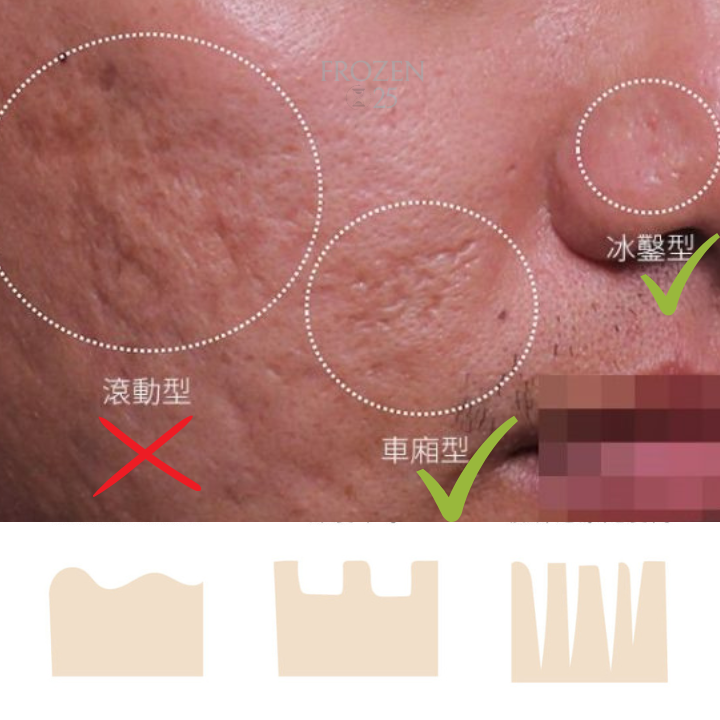 TCA家用產品改善毛孔凹凸洞，讓肌膚更光滑的效果圖