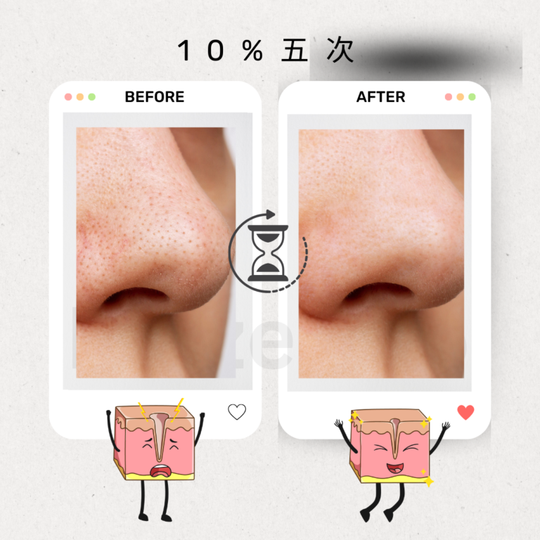 TCA家用產品改善毛孔凹凸洞，讓肌膚更光滑的效果圖