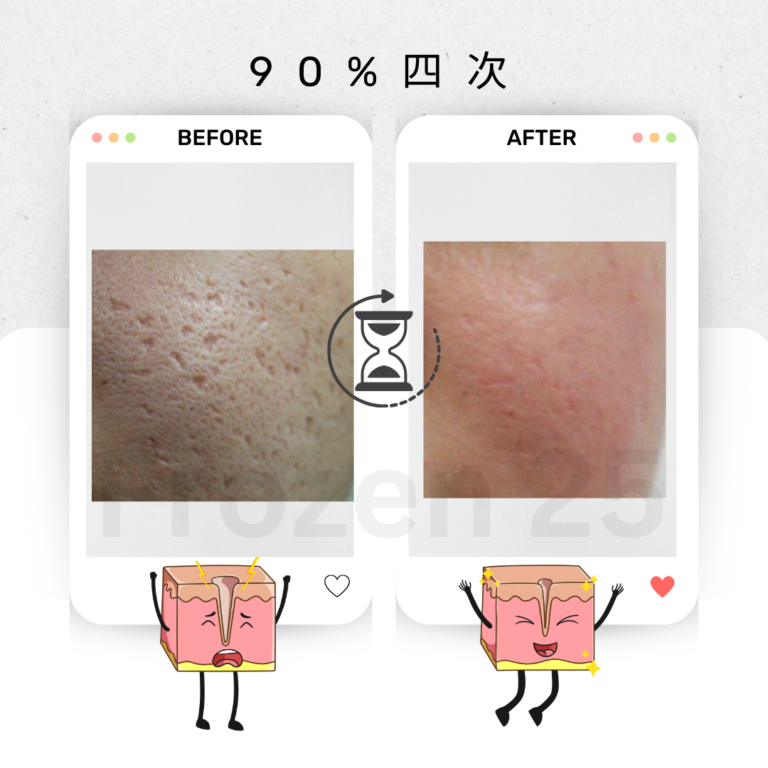 TCA家用產品改善毛孔凹凸洞，讓肌膚更光滑的效果圖