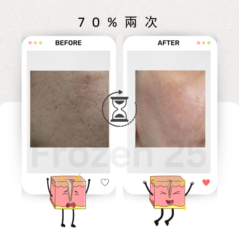 TCA家用產品改善毛孔凹凸洞，讓肌膚更光滑的效果圖