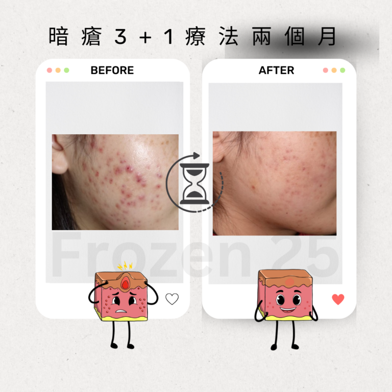 TCA家用產品改善毛孔凹凸洞，讓肌膚更光滑的效果圖