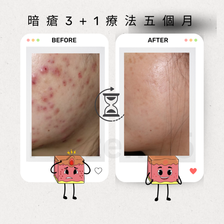 TCA家用產品改善毛孔凹凸洞，讓肌膚更光滑的效果圖