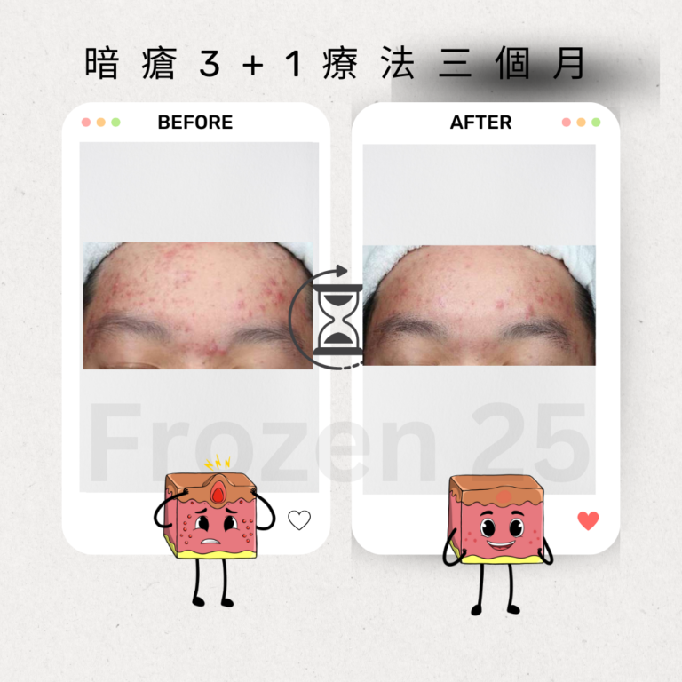 TCA家用產品改善毛孔凹凸洞，讓肌膚更光滑的效果圖