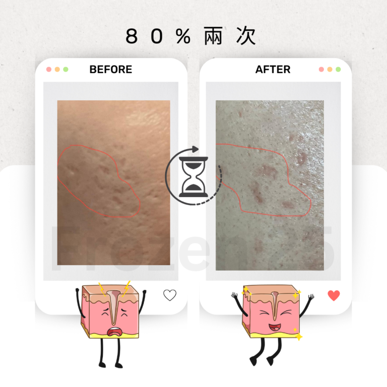 TCA家用產品改善毛孔凹凸洞，讓肌膚更光滑的效果圖