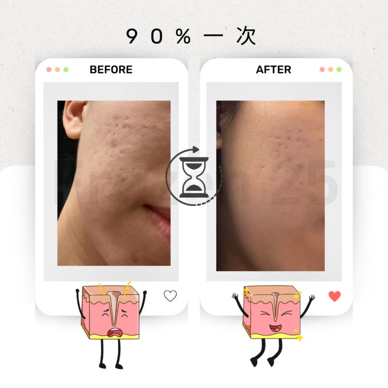 TCA家用產品改善毛孔凹凸洞，讓肌膚更光滑的效果圖